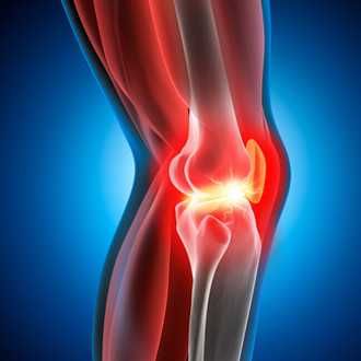 Schematische Darstellung von Arthritis im Knie